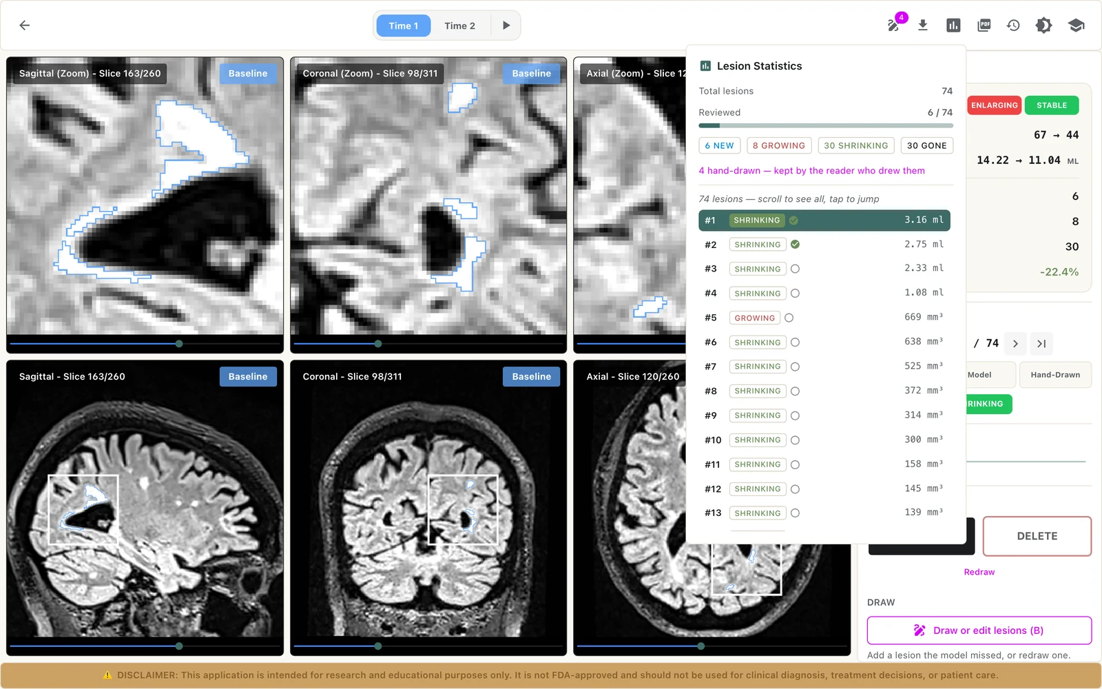 The lesion statistics: lesions reviewed, counts by status and a list of every lesion with its volume