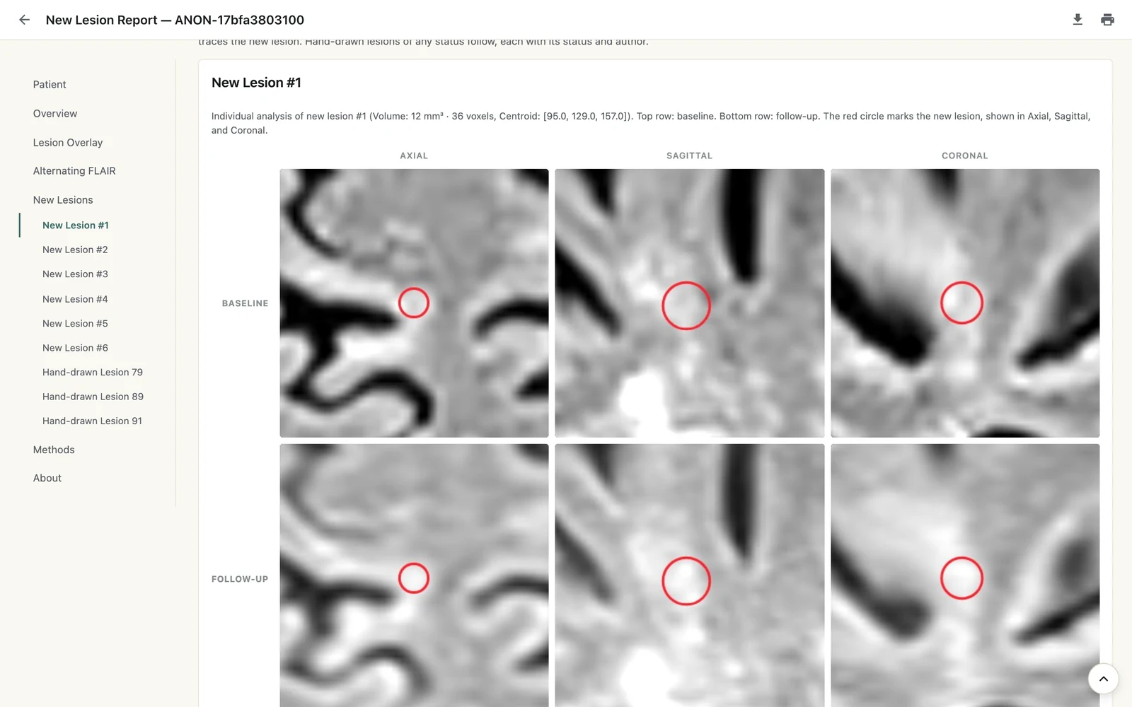 A LAMINATE report page showing one new lesion at baseline and at follow-up in axial, sagittal and coronal views, circled in red