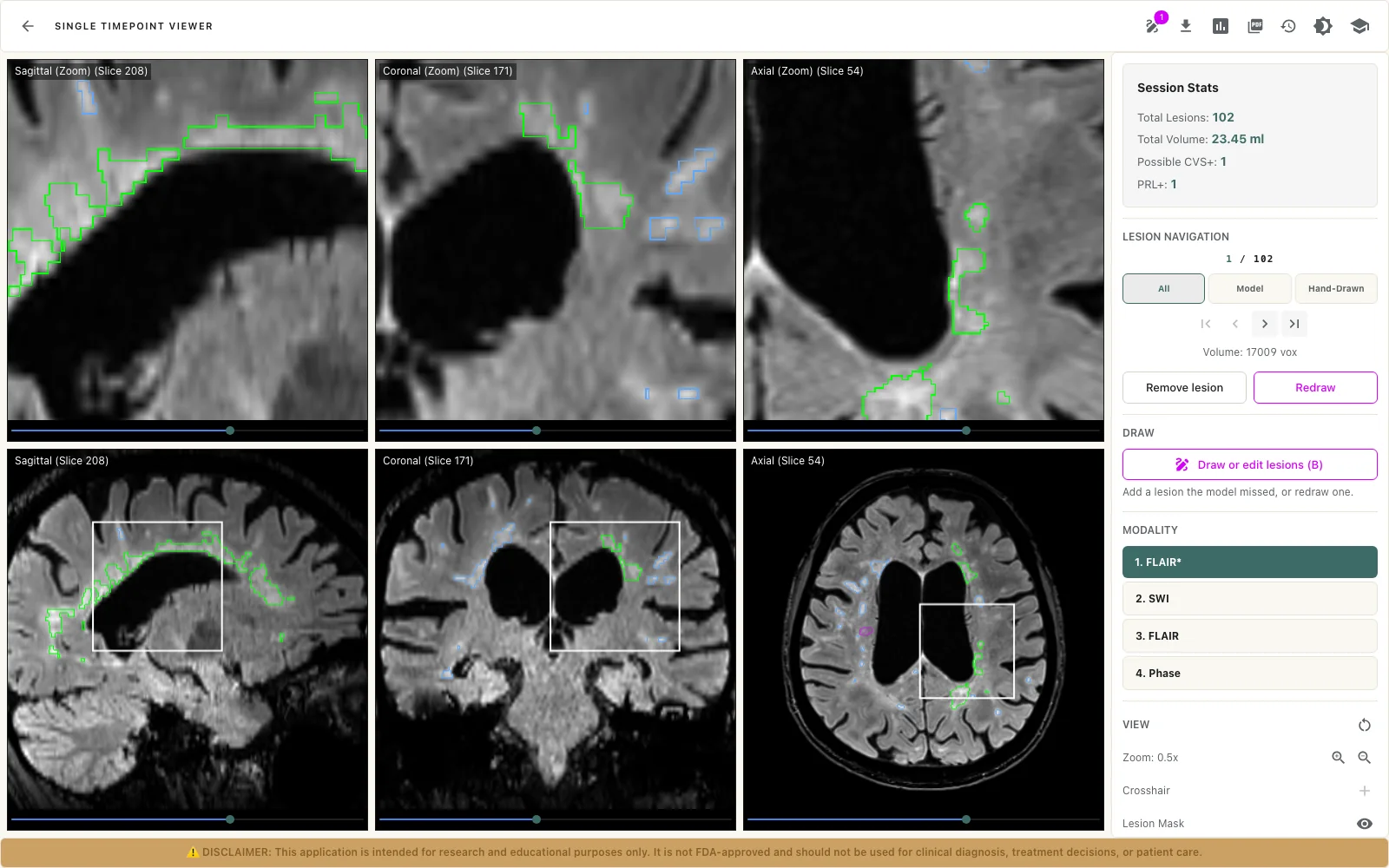 The LAMINATE Single Timepoint Viewer: the FLAIR* image in three planes with lesion outlines, and on the right the session statistics, lesion navigation, drawing tools and modality choices